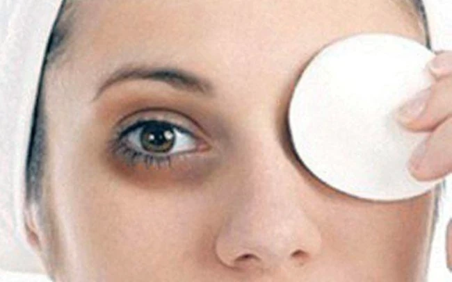 راه درمان سیاهی دور چشم چیست